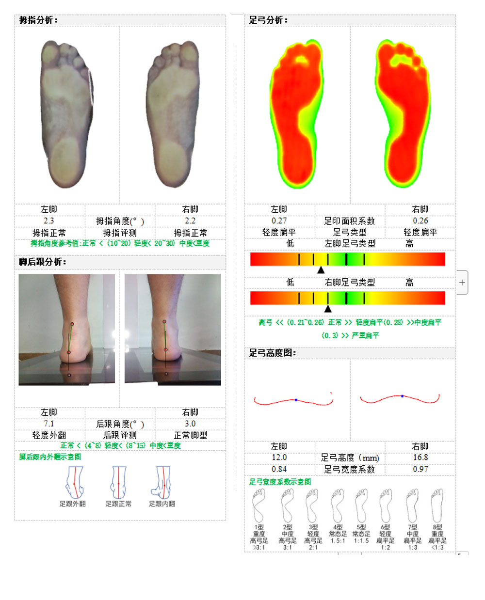 Plantar 3D scanner correction insole foot measurement and analysis arch height, heel turnover deposit